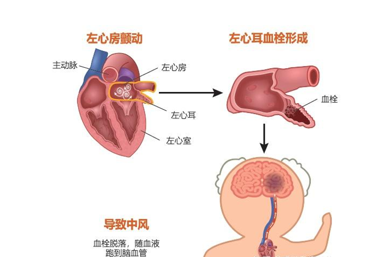 【非瓣膜类疾病】房颤基础知识