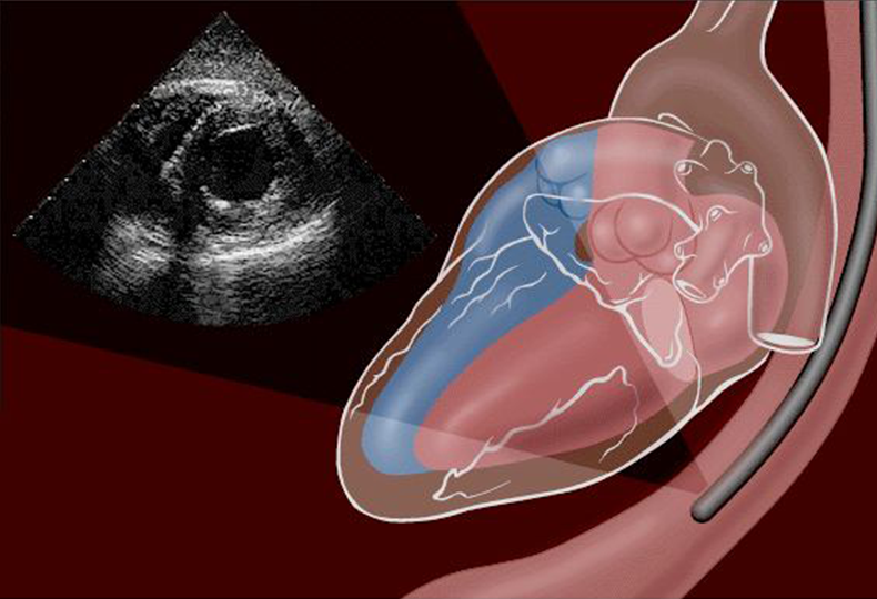 【瓣膜类疾病】人工瓣膜心内膜炎（基础篇）