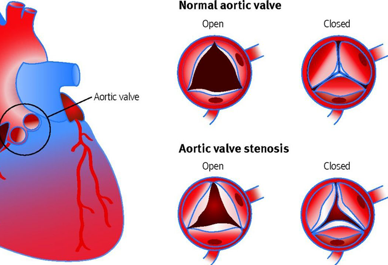 【瓣膜类疾病】主动脉瓣狭窄该如何预防？