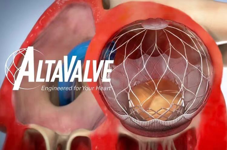 心通医疗联营公司4C Medical经导管二尖瓣置换器械AltaValve™开启关键性临床研究